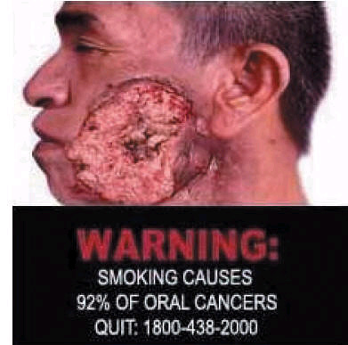 Singapore 2006 Health Effects mouth - oral cancer 2, diseased organ, gross